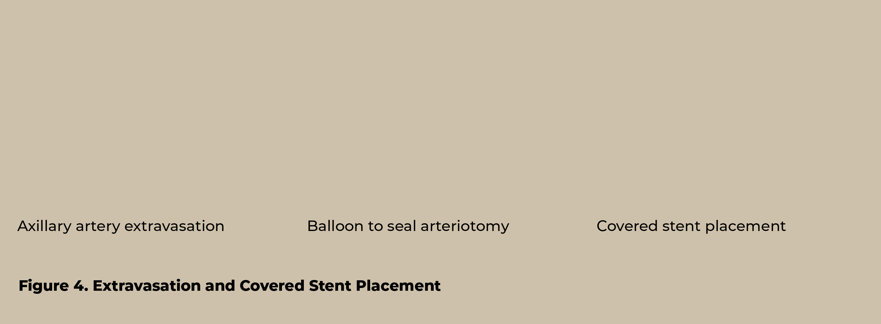 Figure 4  Extravasation and Covered Stent Placement,Balloon to seal arteriotomy,Covered stent placement,Axillary arte   