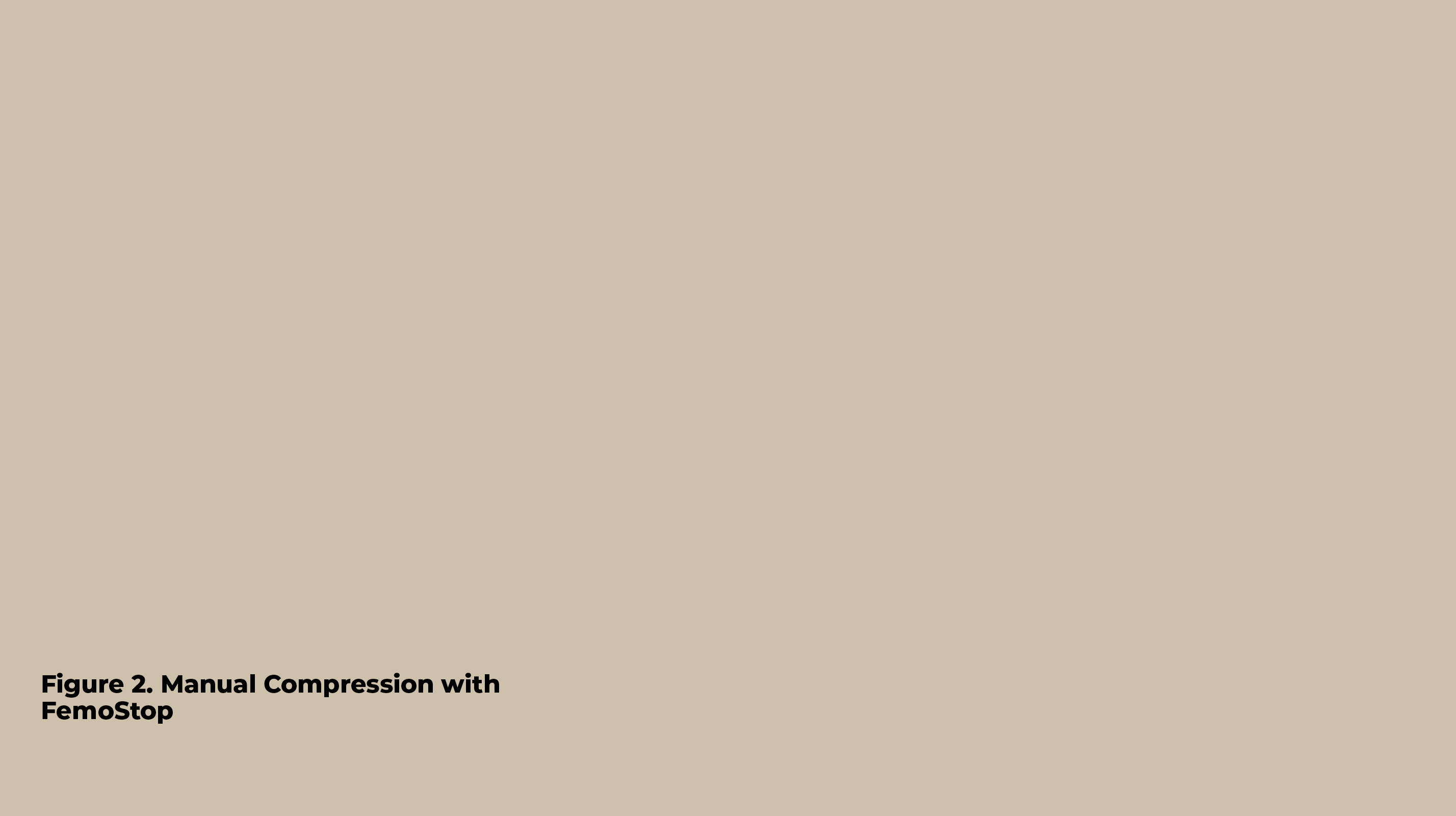 Figure 2  Manual Compression with FemoSto