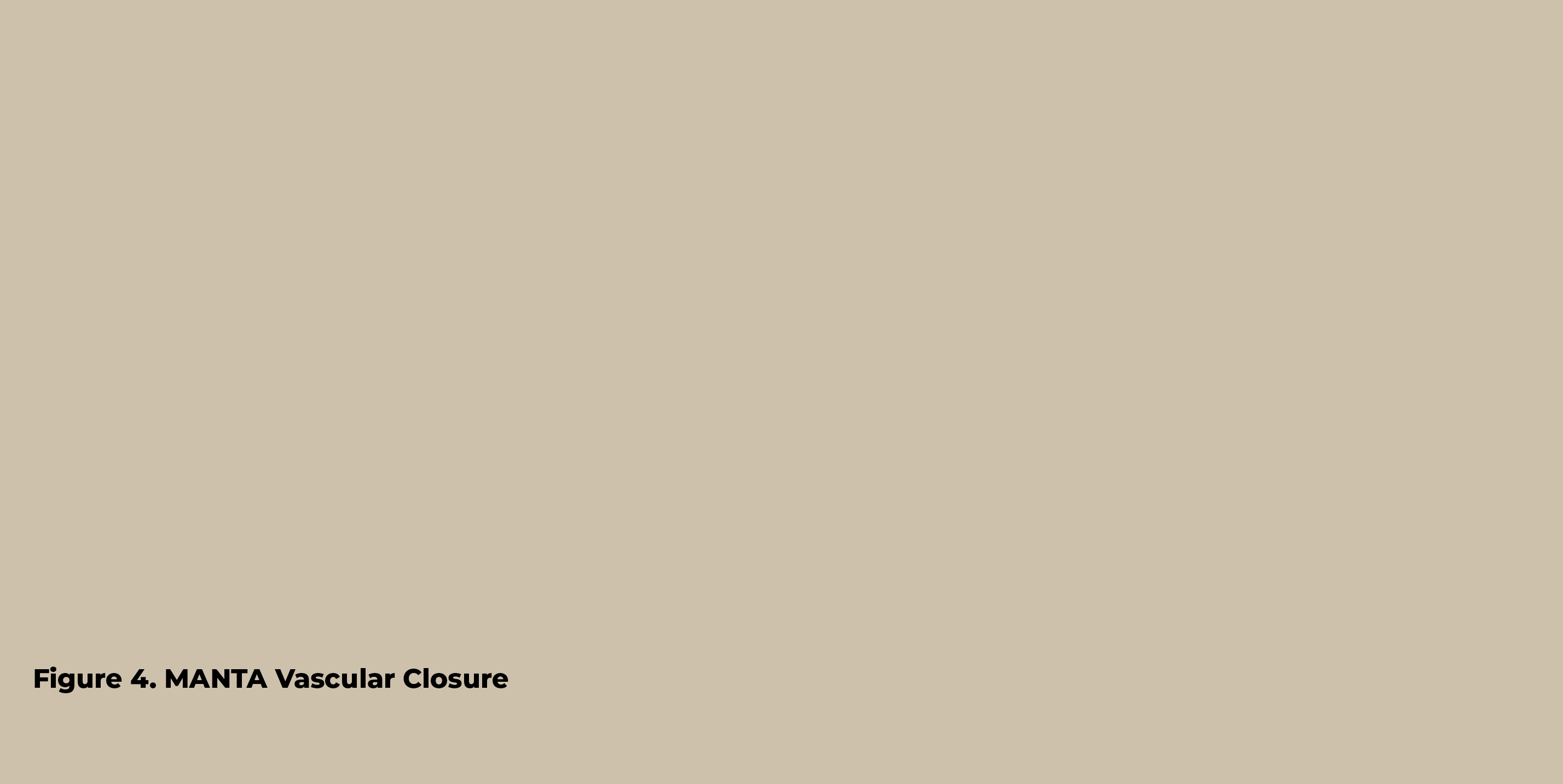 Figure 4  MANTA Vascular Closur