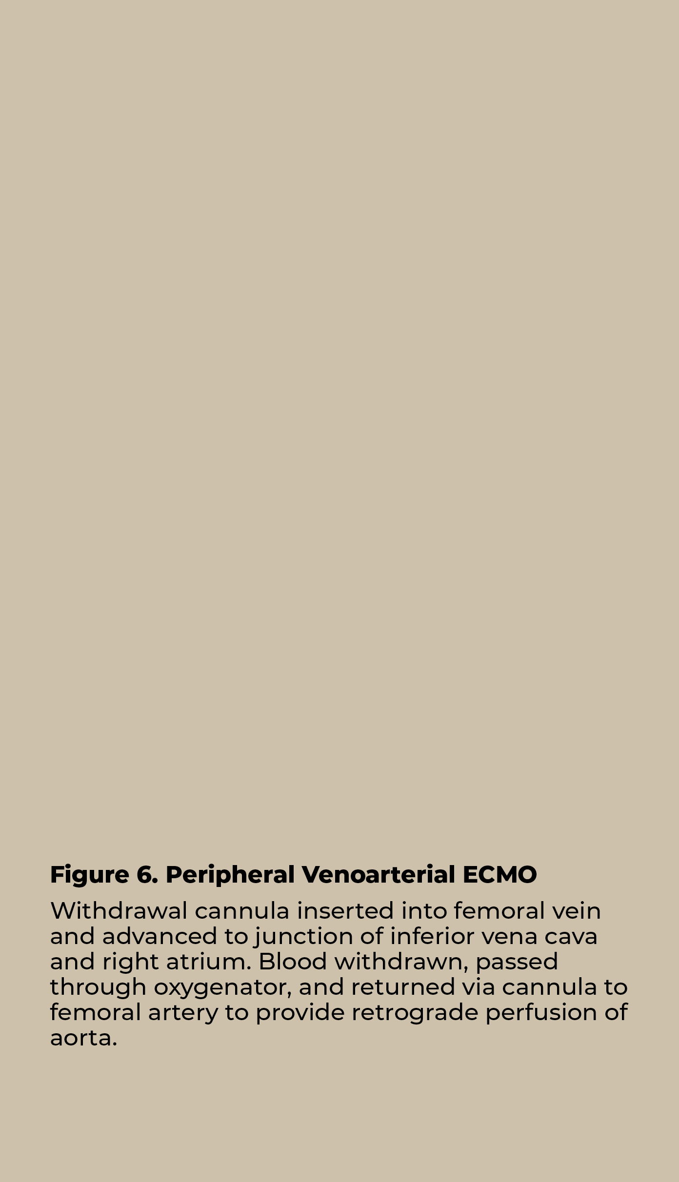 Figure 6  Peripheral Venoarterial ECMO Withdrawal cannula inserted into femoral vein and advanced to junction of infe   