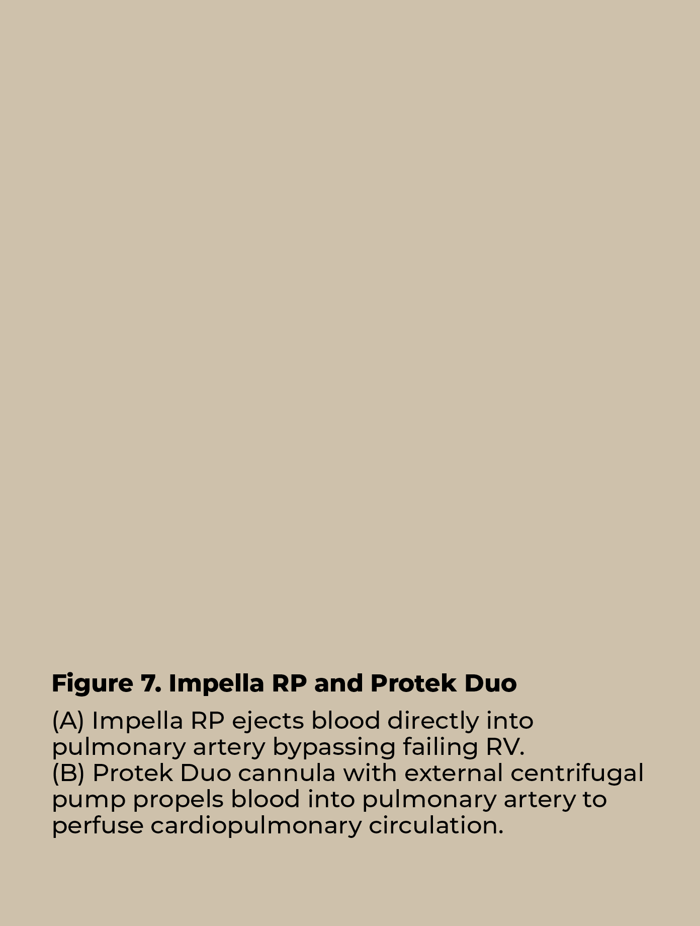 Figure 7  Impella RP and Protek Duo (A) Impella RP ejects blood directly into pulmonary artery bypassing failing RV     