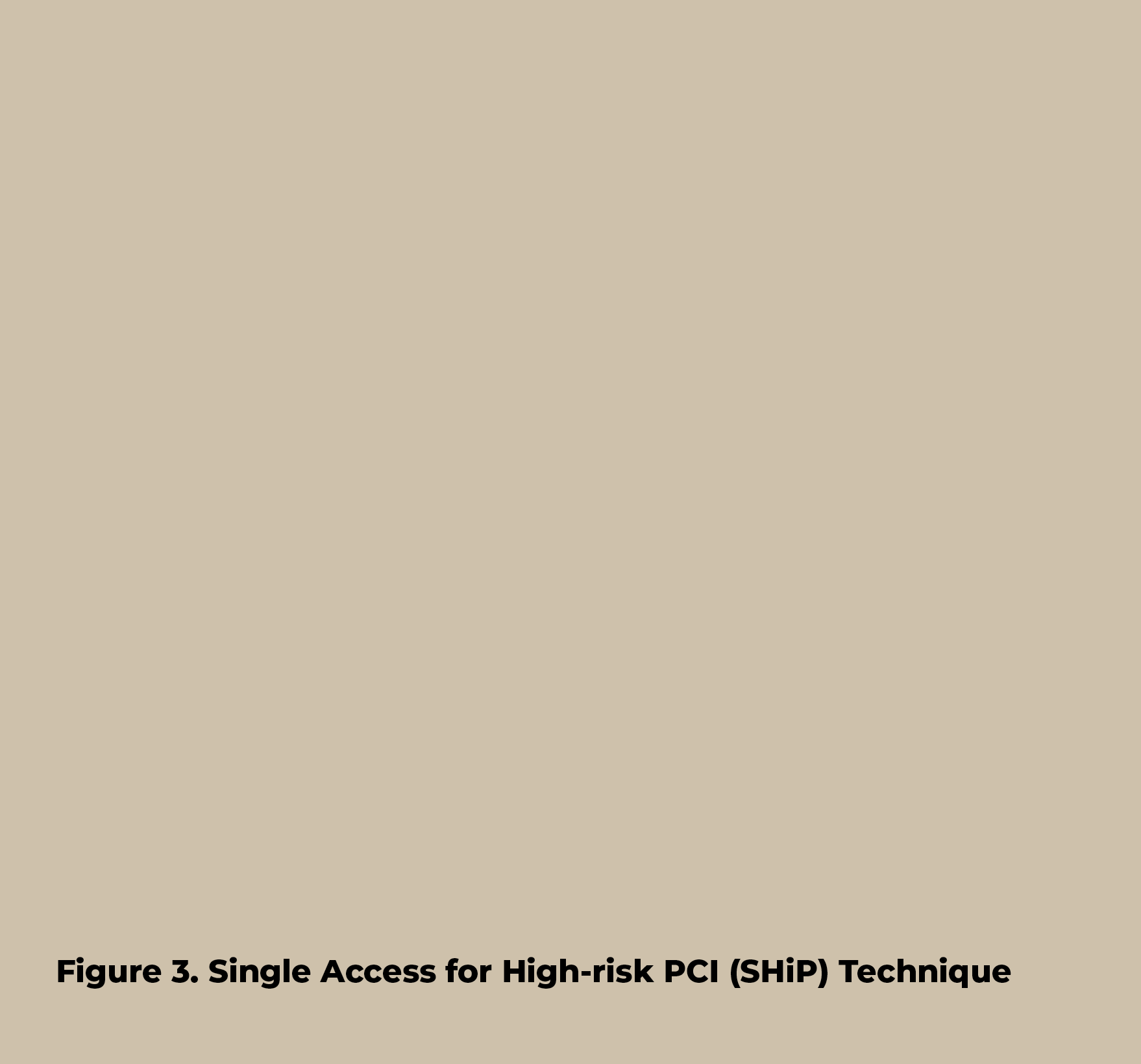 Figure 3  Single Access for High-risk PCI (SHiP) Techniqu