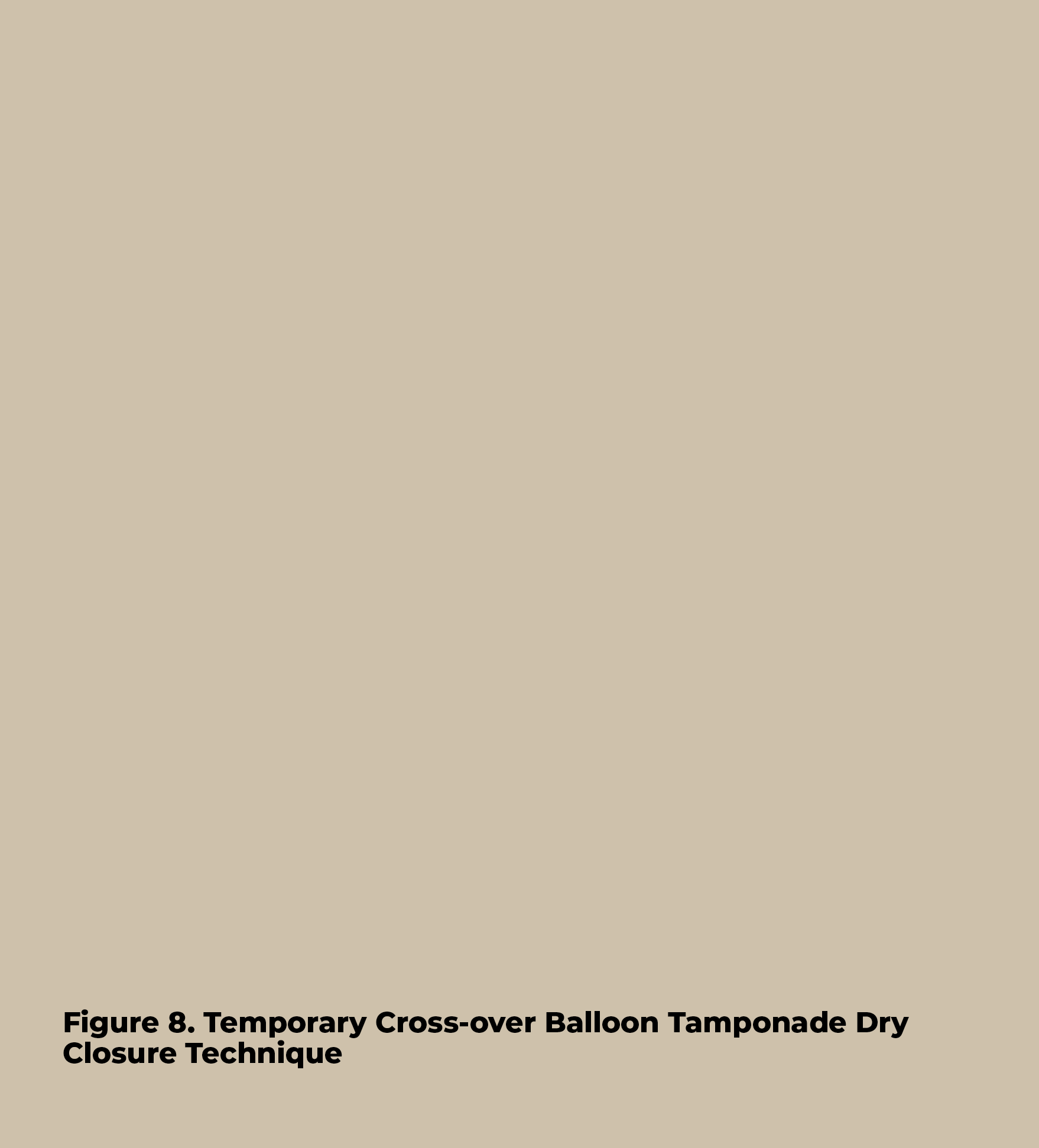 Figure 8  Temporary Cross-over Balloon Tamponade Dry Closure Techniqu