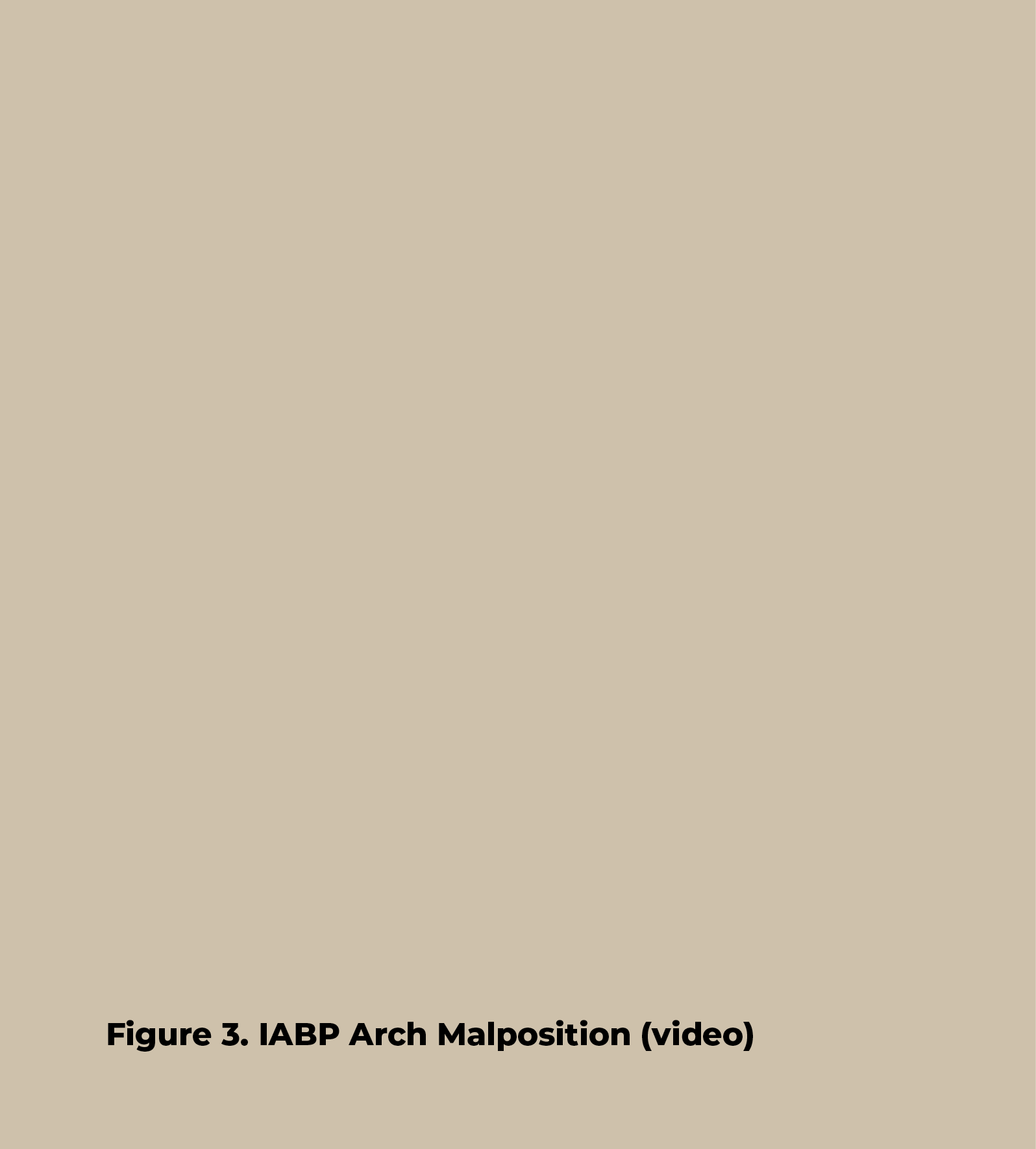 Figure 3  IABP Arch Malposition (video